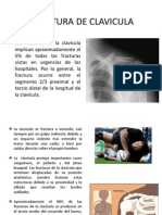 Fractura de Clavicula