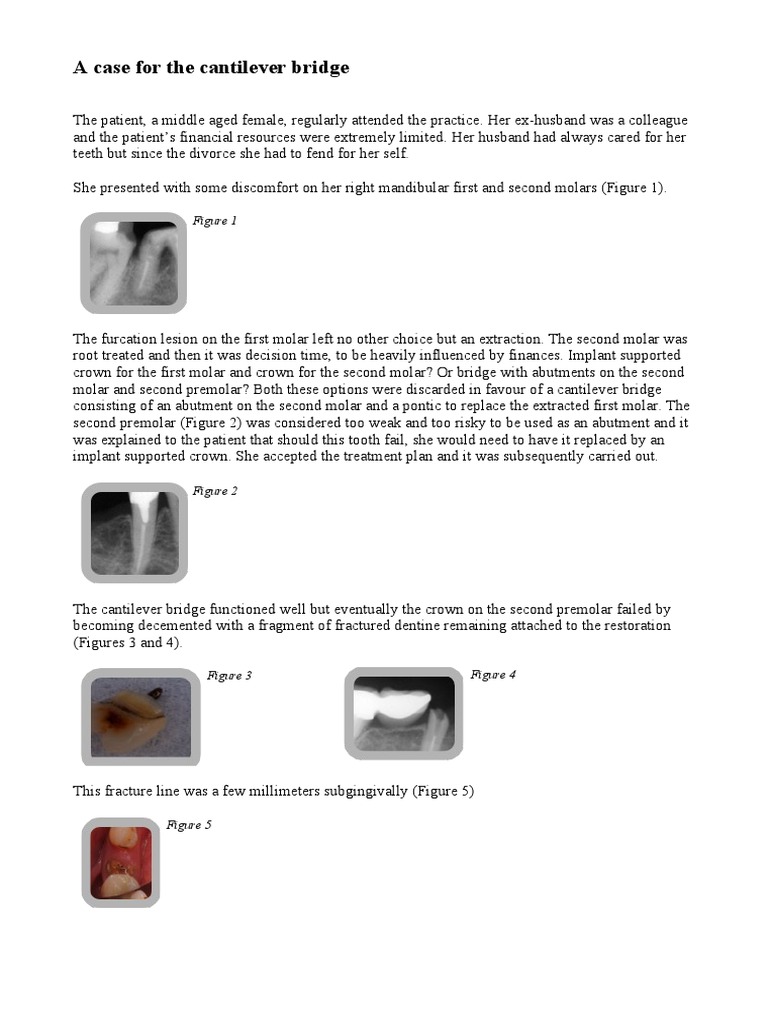 A Case For The Cantilever Bridge | PDF | Dental Implant | Mouth