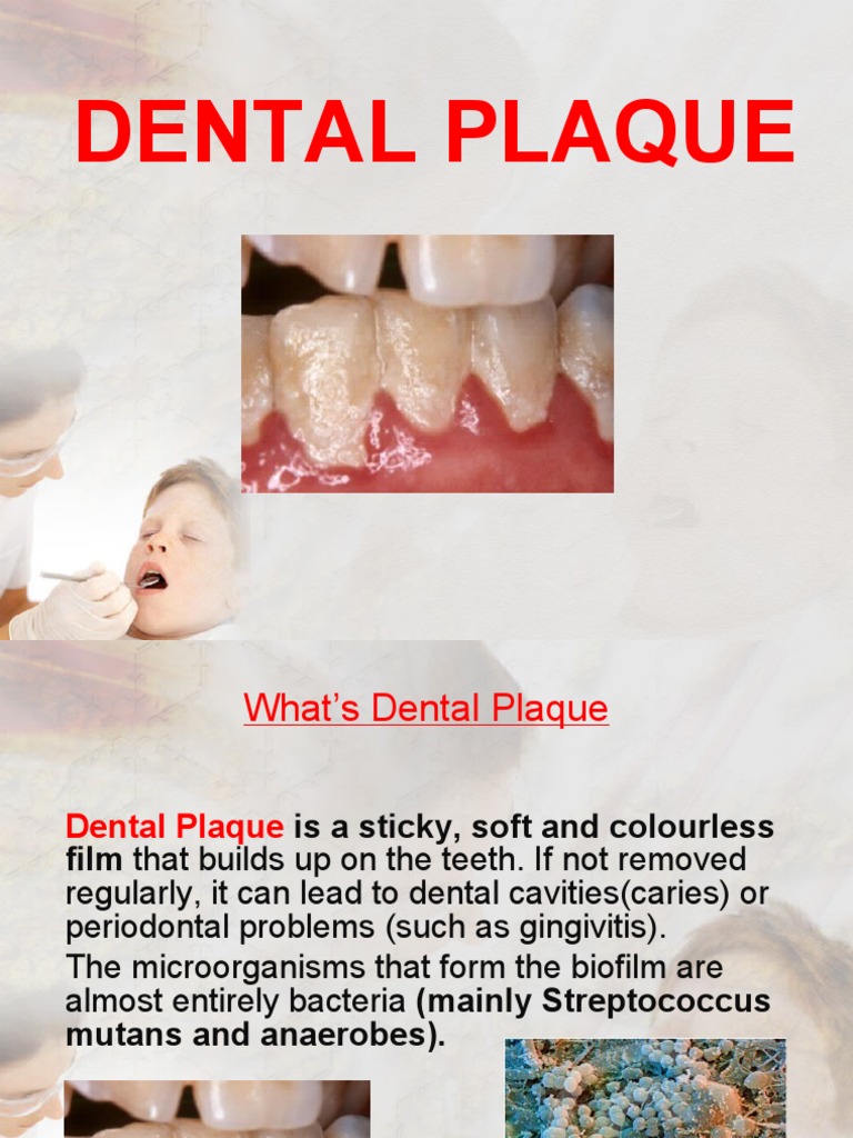 Dental Plaque Presentation PDF Oral Hygiene Dentistry