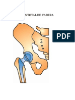 Prótesis de Cadera - Educacion de Pacientes - Doc 1