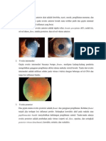 Uveitis Anterior