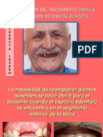 Planificacion Del Tratamiento para La Sustitucion de Dientes Ausentes