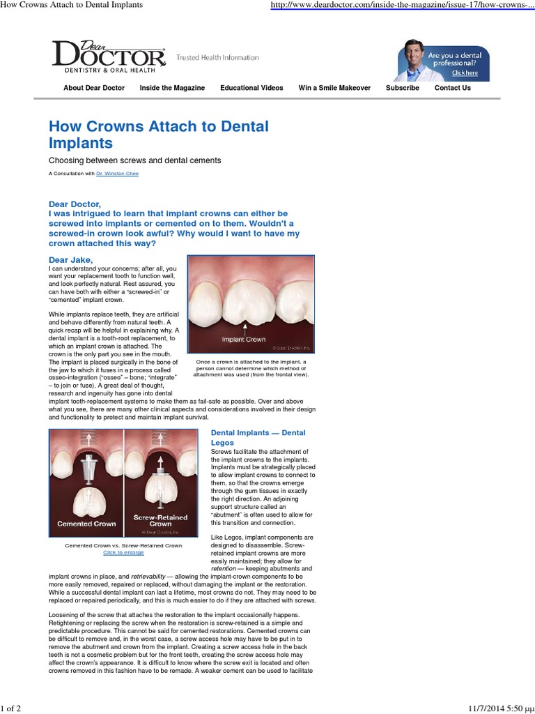 How Crowns Attach to Dental Implants Dental Implant Dentistry