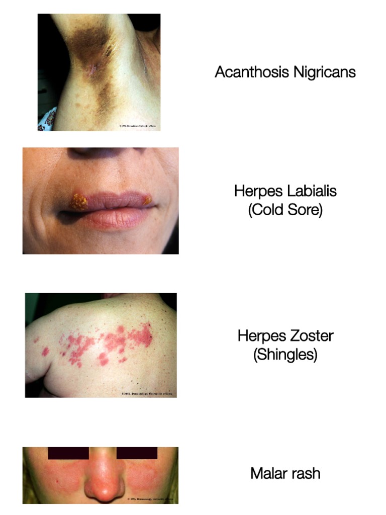Malar Rash and Dermatology Essentials | PDF