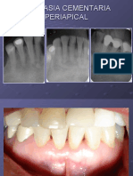 displasia cementaria periapical