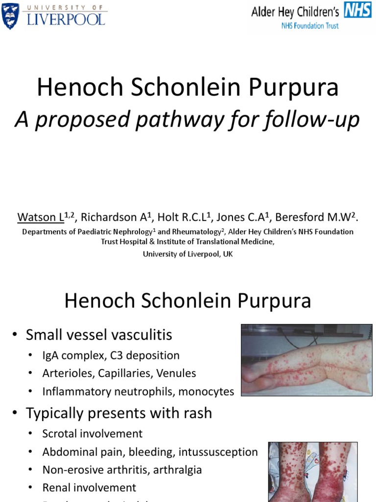 Henoch Schönlein Purpura Management Guidelines | PDF | Clinical ...