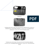 Retained Root + Condensing Osteitis