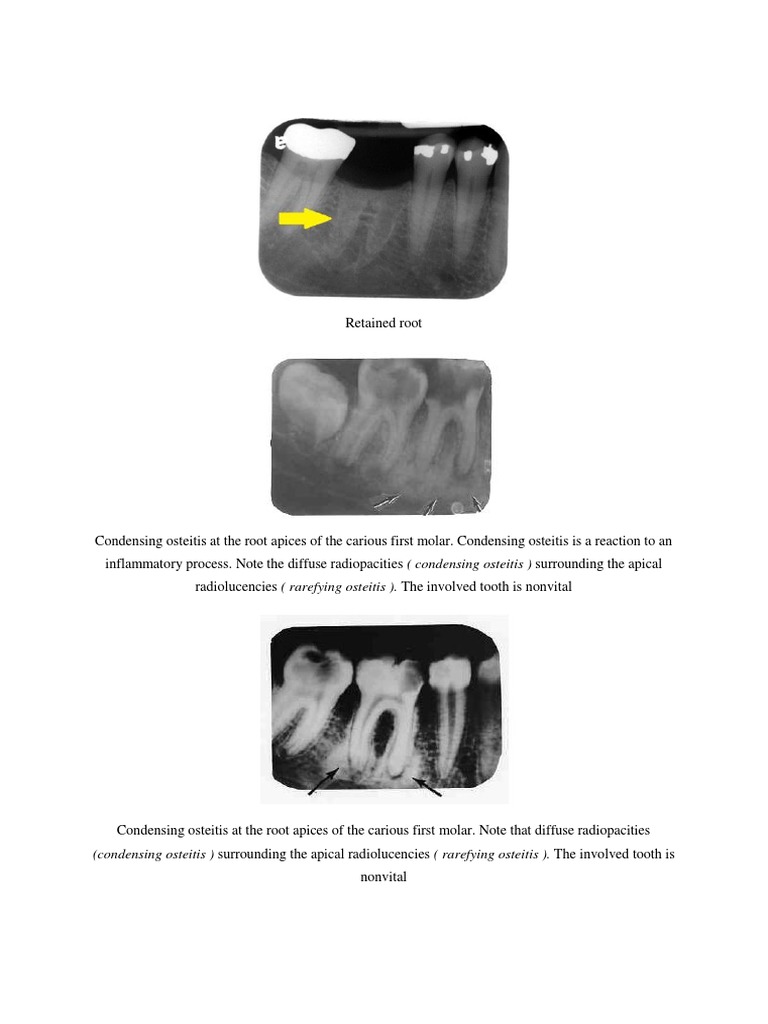 Retained Root + Condensing Osteitis PDF
