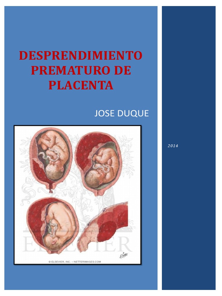 Hematoma Retrocorial Y Sindrome De Down