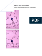 Anestezia Plexala