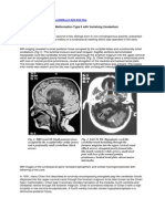 Chiari Malformation