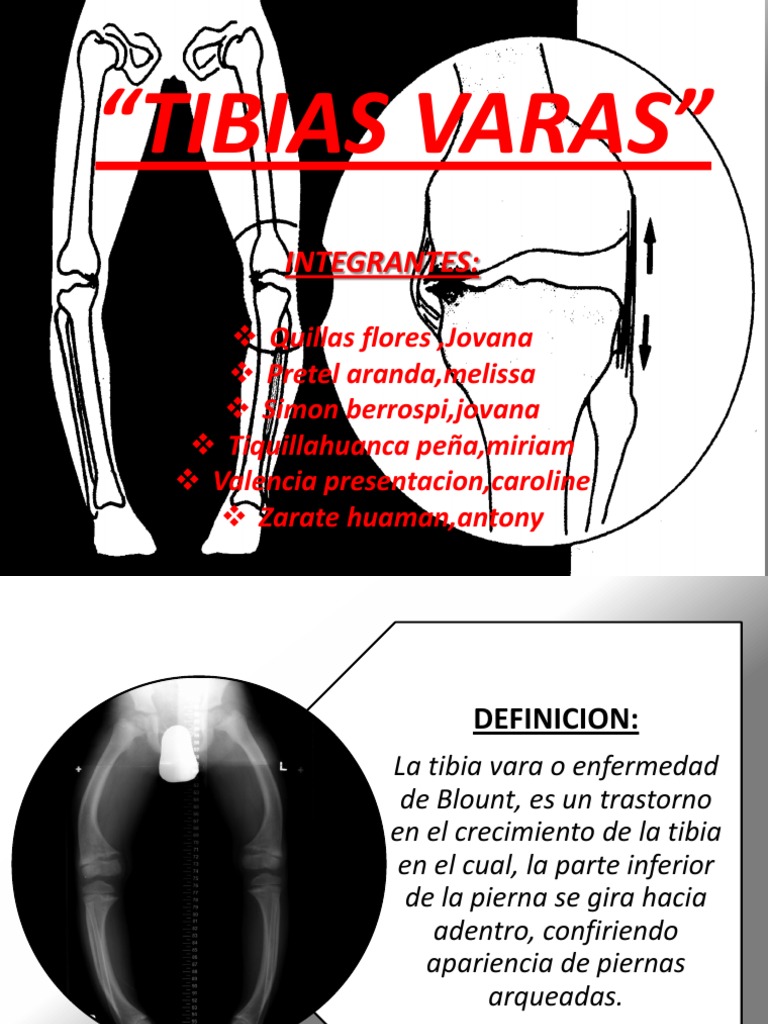 Tibias Varas | PDF | Rodilla | Anatomía humana