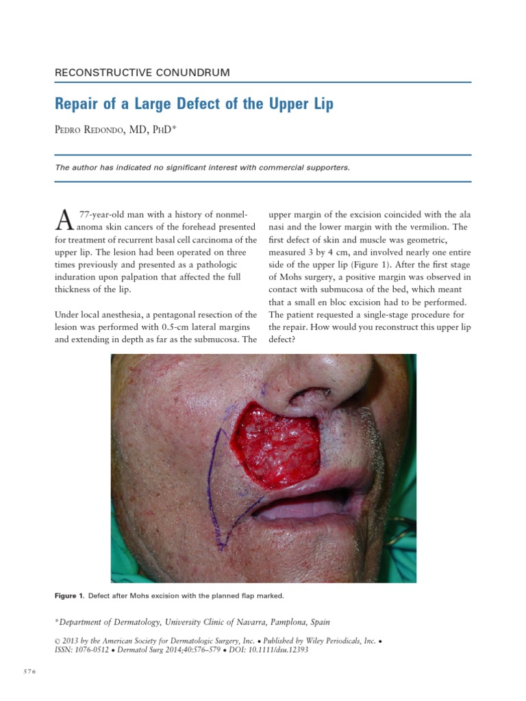 Repair of a Large Defect of the Upper Lip Surgical Suture Lip