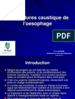 Les Brûlures Caustique de L'oesophage