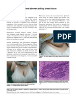 Aberrant Axillary Breast Tissue
