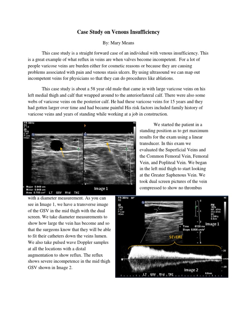 Venous Insufficiency Case Study Analysis | PDF | Varicose Veins | Vein