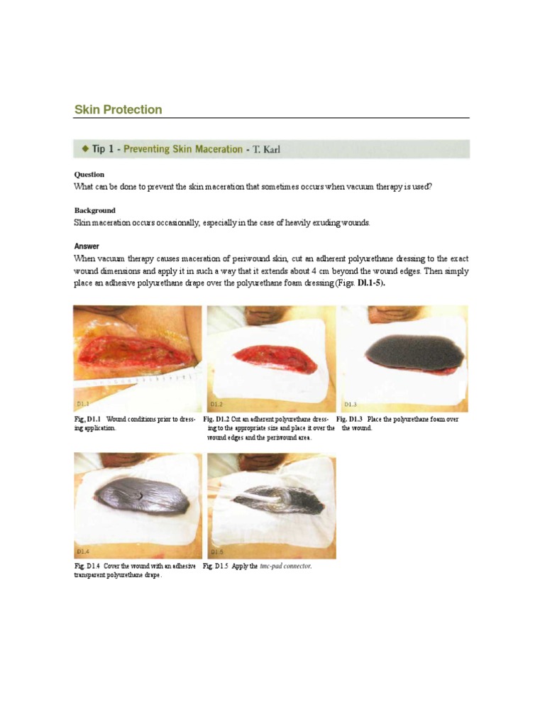 Tips of Operations VAC therapy Wound Foam