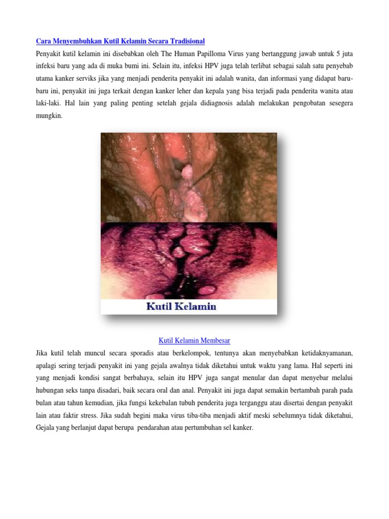 Cara Menyembuhkan Kutil Kelamin Secara Tradisional
