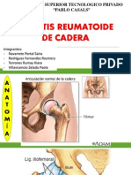 Artritis de Cadera