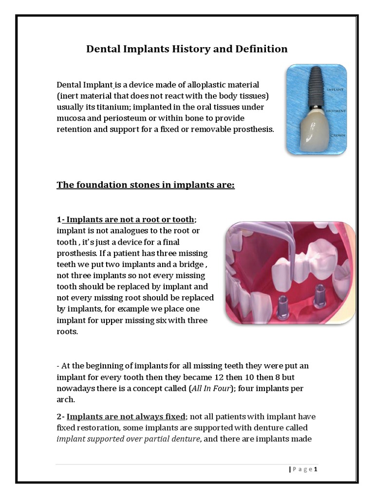 Dental Implants History and Definition.docx Dental Implant Dentures