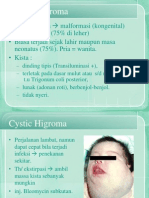 Cystic Higroma