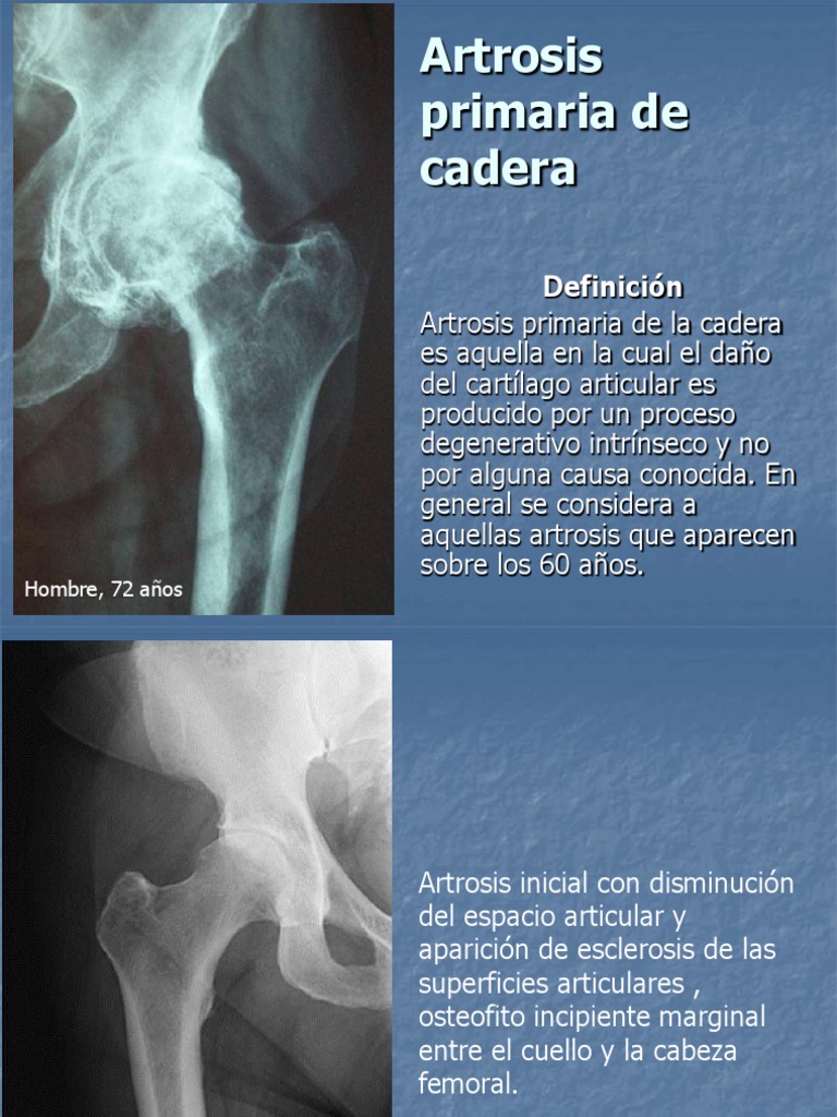 artrosis-de-cadera-pdf-cadera-osteoartritis