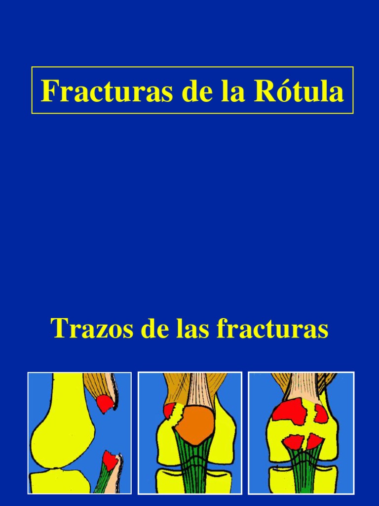 Clasificación y Tratamiento de Fracturas de Rótula | PDF | Rodilla ...