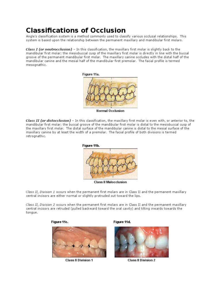Classifications of Occlusion PDF Human Anatomy Mouth
