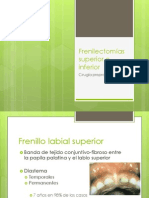 Frenilectomias.pptx