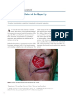 Repair of a Large Defect of the Upper Lip