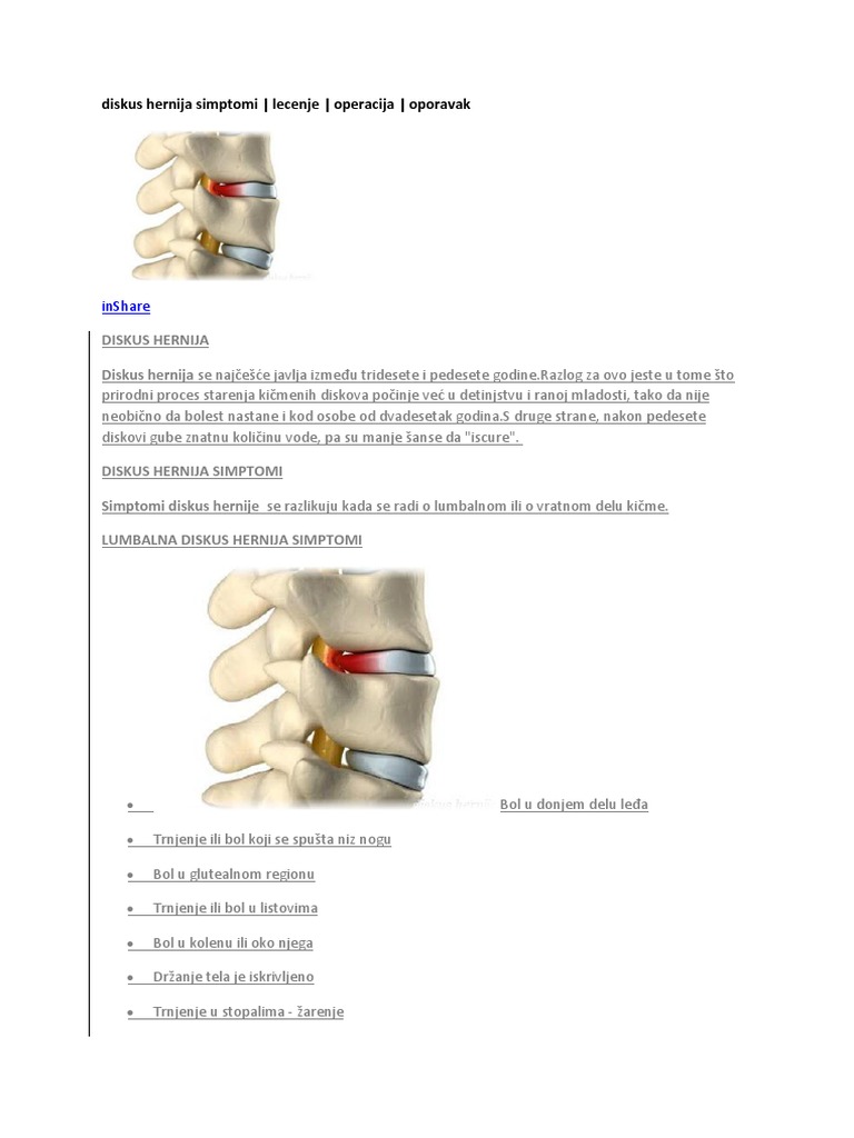 Diskus Hernija Simptomi PDF