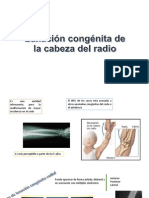 Luxación Congénita de La Cabeza Del Radio