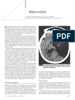 Infarto Cerebral PDF