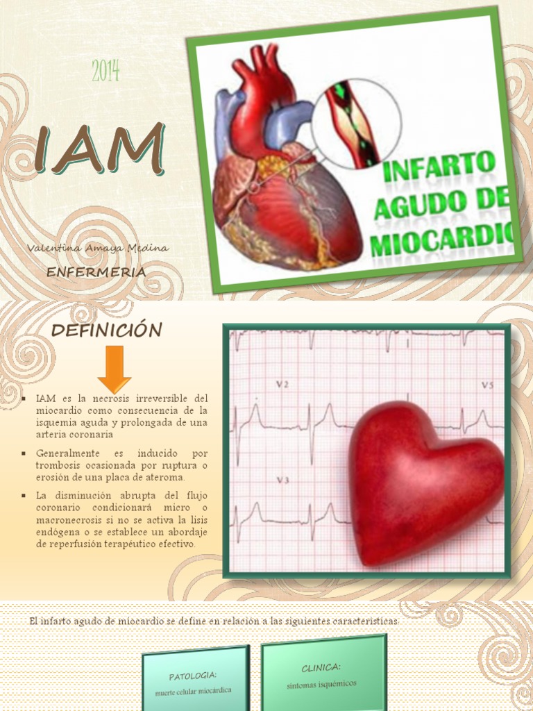 IAM | PDF | Infarto de miocardio | Insuficiencia cardíaca