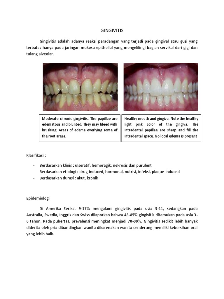 Gingivitis PDF