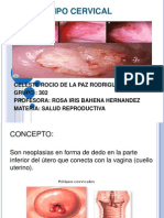 Polipo Cervical