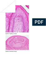 Papilloma-Papilliferous Subtype
