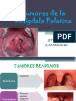 Carcinomas de La Amigdala Palatina