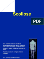 Scolioza