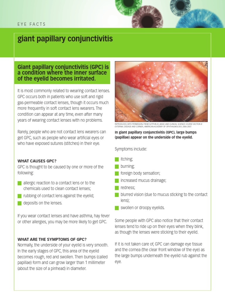 Giant Papillary Conjunctivitis AAO Contact Lens Allergy
