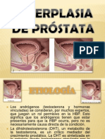Hiperplasia de Prostata