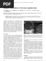 Malignant Mesothelioma of The Tunica Vaginalis Testis: Case Report