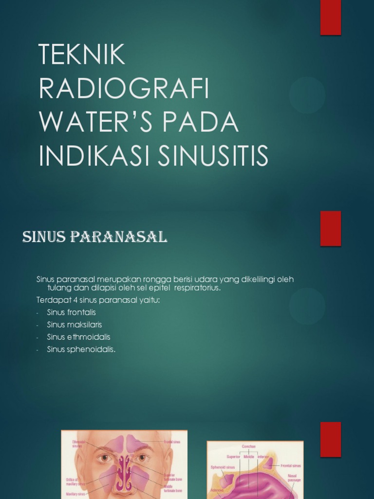 Teknik Radiografi Water's Pada Indikasi Sinusitis | PDF