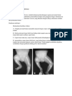 Proximal Femoral Focal Deficiency Adalah Kelainan Perkembangan Segmen Proximal Femur