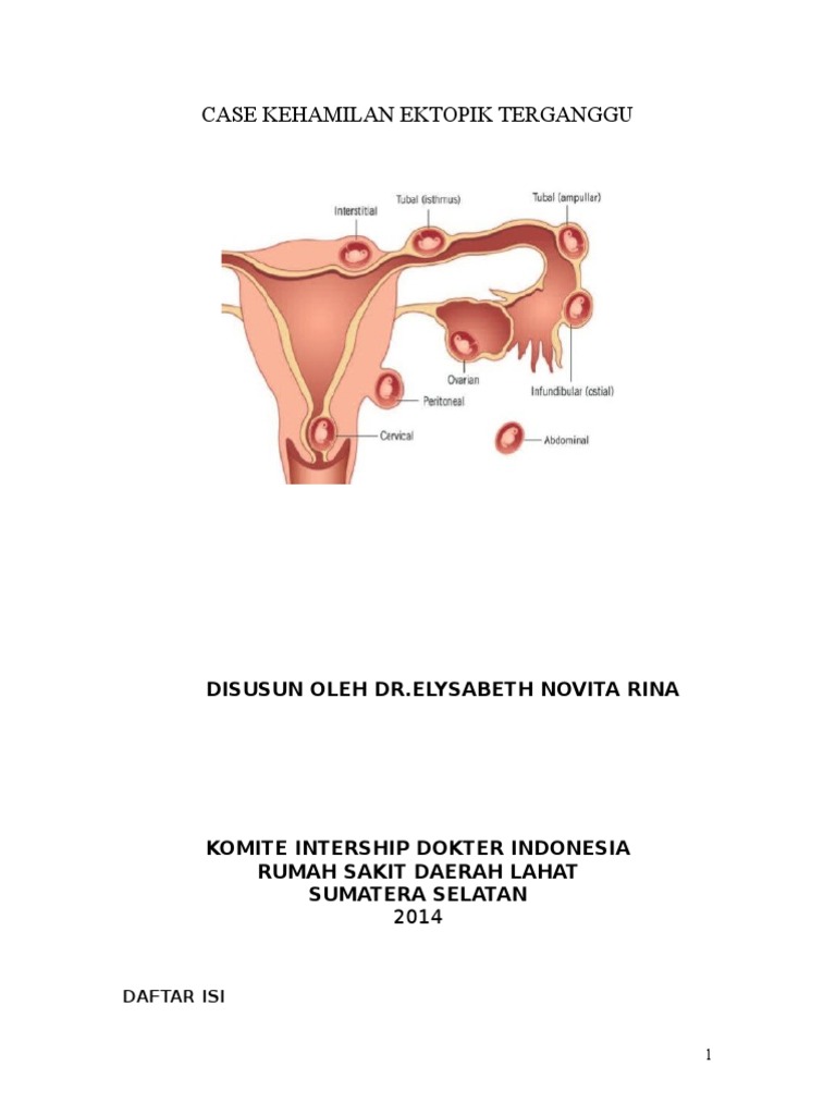 Kehamilan ektopik terganggu