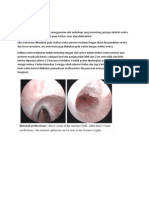 Uretrotomi Interna