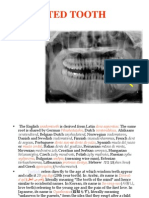 Impacted Tooth