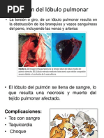 Torsión del lobulo Pulmonar