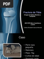 Fractura Tibia