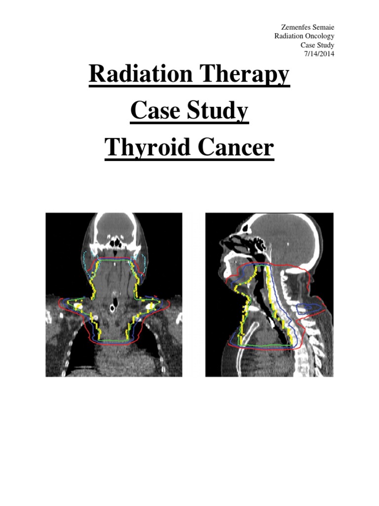 Radiation treatments for thyroid cancer